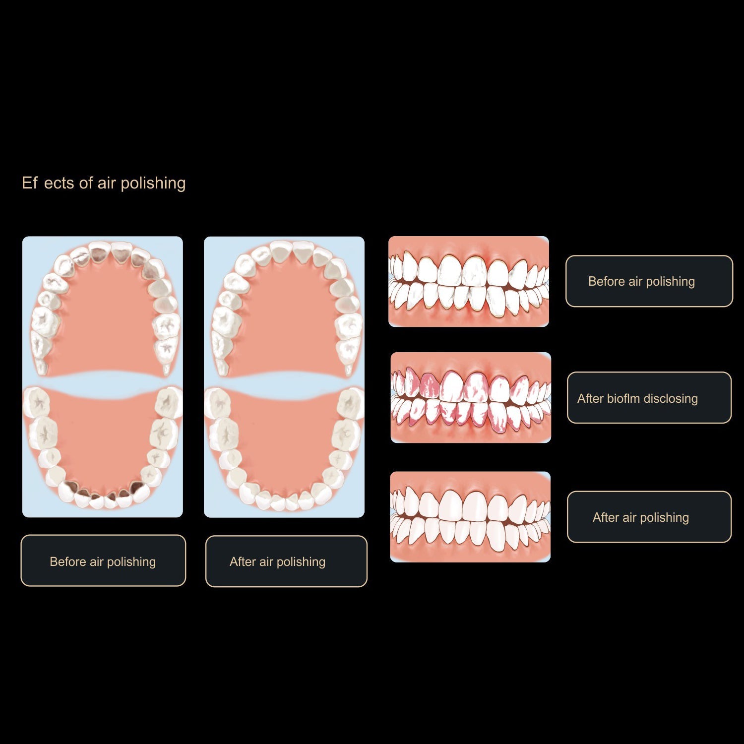Woodpecker Air Polisher Subgingival Air Polishing Nozzle 10/pk