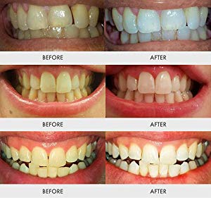 teeth whitening results