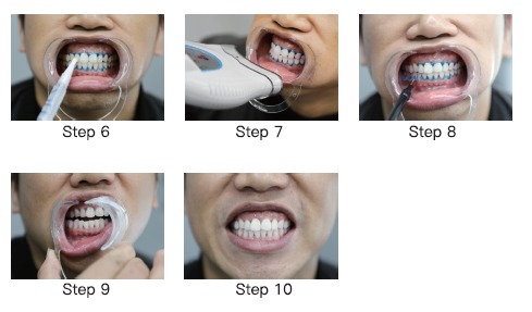 zoom teeth whitening