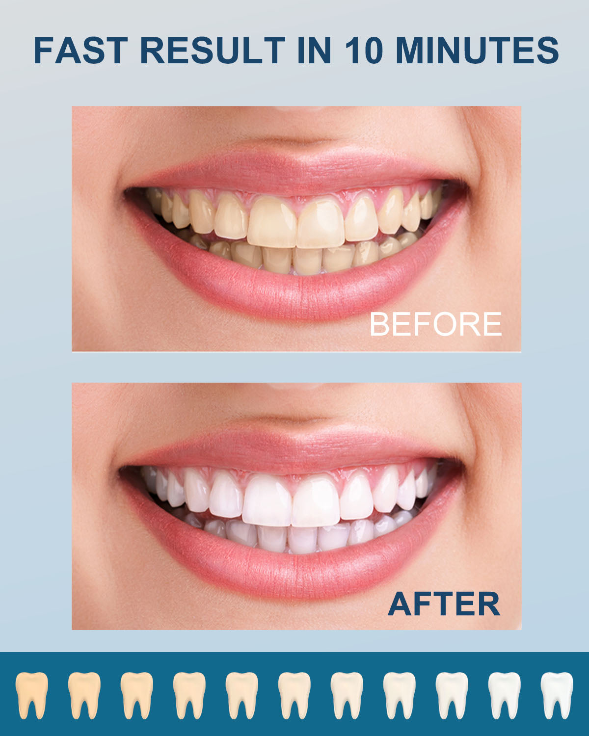 MySmile® Premium Home Teeth Whitening Kit
