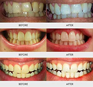 teeth whitening result